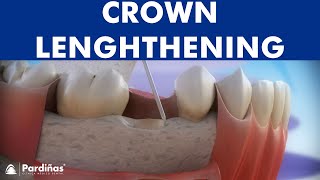 Dental crown lengthening © [upl. by Thordis]