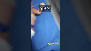 MAS Meconium Aspirated Syndrome meconium syndrome aspiration ytshorts ytfeed nursingofficer [upl. by Nnaeed]