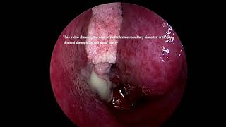 Left sided chronic maxillary sinusitis with pus [upl. by Cordle717]