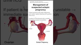 Management of suspected ectopic pregnancy [upl. by Mufinella333]