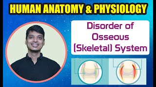 Disorder of OsseousSkeletal System Chapter4 Part6  DPharm ER2014T [upl. by Seiuqram313]