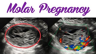 Molar Pregnancy on Ultrasound  Gestation Trophoblastic Disease  Complete Hydatidiform Mole [upl. by Drake]