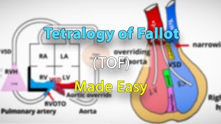 Tetralogy of Fallot TOF anatomy pathophysiology clinical features and diagnosis  Made easy [upl. by Anole]