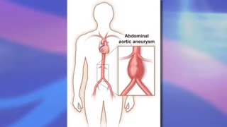 Risks and Benefits of Endovascular Abdominal Aortic Aneurysm Repair EVAR [upl. by Nachison]