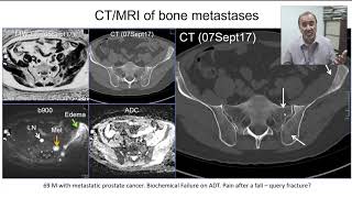 Bone metastases – One Disease with Many Signs [upl. by Cindee]