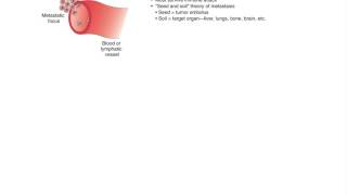 Pathology Neoplasia Part 1 [upl. by Aynav]