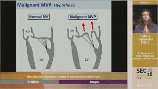Diagnóstico y manejo de la insuficiencia mitral en 2018 [upl. by Adine]