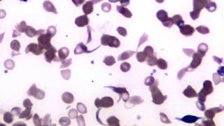 Blood Sickle Cell Anemia [upl. by Dranyl411]