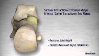 Subtalar Joint Distraction [upl. by Aikemet]