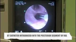 Bronchial Thermoplasty in Serdang Hospital Malaysia [upl. by Airottiv222]