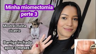 Minha miomectomia  parte 3 [upl. by Ert]