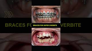 Braces for super overbite and super crowded teeth braces orthodontist bracket dentist teeth [upl. by Cima]