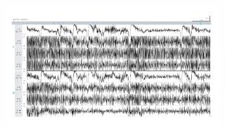 EEG Atlas B1 Recognize Common Artifacts Seen on EEG Using The Ceribell Rapid Response System [upl. by Nosreg]