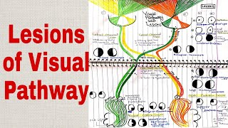 Lesions of Visual Pathway Part 3 [upl. by Aiuhsoj]