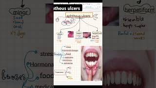 Aphthous ulcers dental dentistrydegree dentistdoctor dentistrystudent [upl. by Ttayh571]