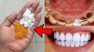 Magic Teeth Whitening  Remove Plaque and Tartar Fast 🧙‍♂️✨ [upl. by Nodnnarb593]