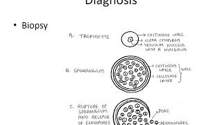 Rhinosporidiosis  ENT Lecture Series [upl. by Eilata]