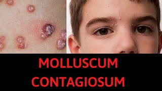 What is Molluscum Contagiosum Symptoms Treatment [upl. by Nerrej]