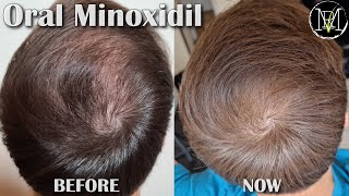 Oral Minoxidil Loniten Results in 10 Months [upl. by Lucilia586]