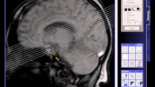 Brain MRI Diperiventrikulerlacunar infarction left ventricular lateral [upl. by Jt]