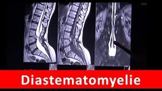 Diastematomyelie  Magnetresonanztomographie  by Radiologie TV [upl. by Azilanna13]