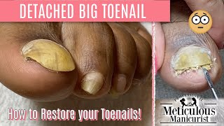 How To Pedicure Transformation for Men on Detached Toenails [upl. by Jarin]