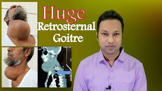 Huge Thyroid Enlargement Retrosternal or Substernal Goitre । Risk of Tracheomalacia amp Management [upl. by Pages]