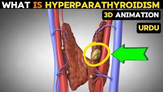 What is hyperparathyroidism causessymptoms and treatment [upl. by Esylle]