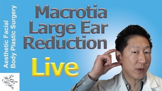 LARGE EAR MACROTIA REDUCTION OTOPLASTY SURGERY Patient True Story Live Surgery Before amp Afters [upl. by Aisaim]