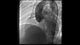 Aortopulmonary window LAOCranial view [upl. by Piks]