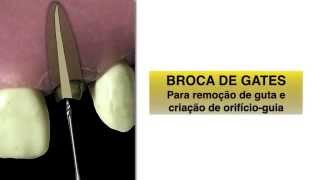 COMO FAZER UM PREPARO INTRACANAL PARA PINOS DE FIBRA DE VIDRO SEM USAR BROCAS ESPECIAIS [upl. by Peltier660]