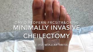 Minimally Invasive Cheilectomy For Hallux Rigidus [upl. by Stearne]