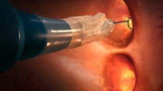 How Cryoballoon ablation works [upl. by Aalst]