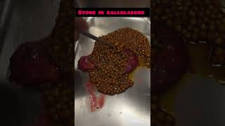 gallbladder stone gallbladderstone [upl. by Nomolos147]