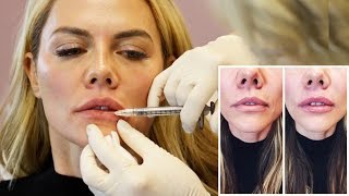 Natural Lip Injection Experience and Botox from Doctor Cynthia Cote [upl. by Haelhsa]