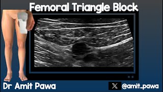 Femoral Triangle Block [upl. by Burkhart]