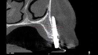 IMPORTANCE OF HAVING COMMON SENSE AND IN HOUSE CBCT IN IMPLANTOLOGY  discussion by drcmurugavel [upl. by Cath]