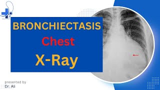 Bronchiectasis X Ray Bronchiectasis Chest X Ray Findings [upl. by Jehius231]