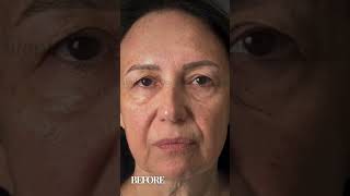 Oculoplastica  Prima e Dopo Ptosis Asimmetria palpebre Blefaroplastica 2 0 [upl. by Nevanod]