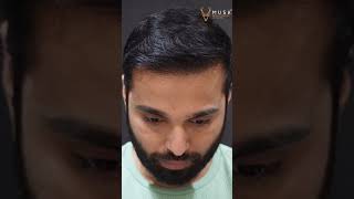 360 Days Results Of Hair Transplant  Artas Robotic Hair Restoration  Hair Transplant in Ahmedabad [upl. by Ylahtan]