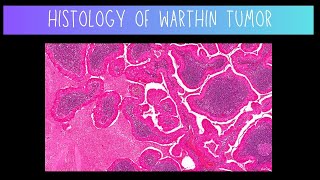 Histology of Warthin Tumor  Dentistry [upl. by Nickey]