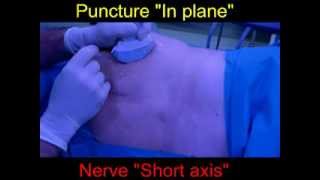 Ultrasound Sciatic Nerve Blockade Casals Approach part1 [upl. by Gaston168]