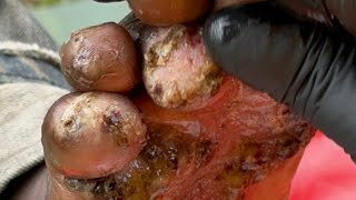 Chrispus feet deformed because of jiggers  watch full video riseupsocietynet SUBSCRIBE [upl. by Leummas]