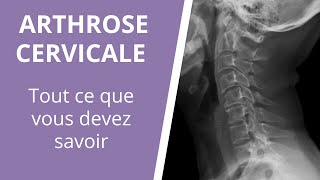 Tout ce que vous devez savoir sur larthrose cervicale  causes symptômes et traitements [upl. by Feirahs423]