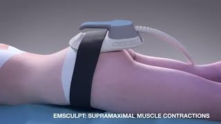 Emsculpt MOA for noninvasive butt lift [upl. by Floridia]