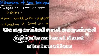 Congenital and acquired nasolacrimal duct obstruction  CNLO  ANLO [upl. by Notnelc]