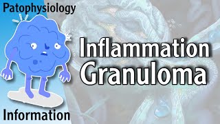 Granuloma  Granulomatous Inflammation شرح [upl. by Thora412]