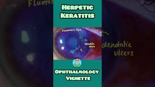 Herpetic Keratitis made simple for USMLE NEET PG NCLEX INICET [upl. by Intosh]