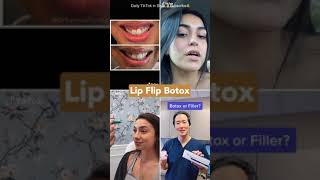 botox lip flip before and after [upl. by Guenna]