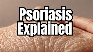 Autoimmune disease Psoriasis A Deep Dive into Skin Health [upl. by Ellwood292]